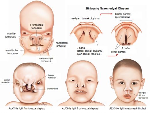Kistik Fibrozis Nedir?