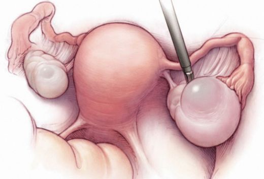 Yumurtalık Kistik Lezyon Nedir?
